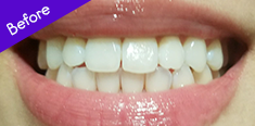 Teeth Before Using BURST Oral Care